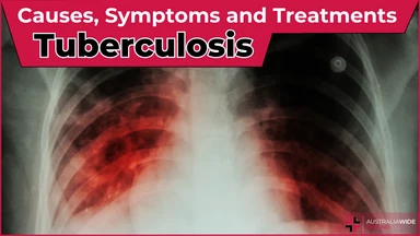 Tuberculosis article header – First Aid Article in Queanbeyan
